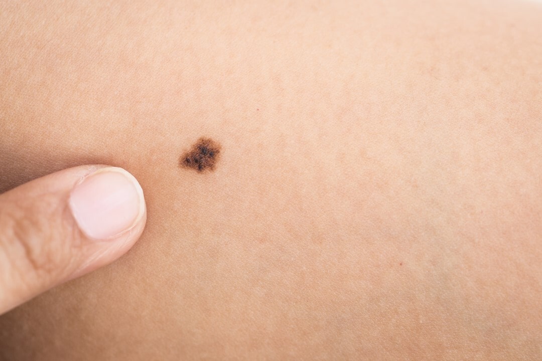 Nốt ruồi là những chấm đen xuất hiện trên da