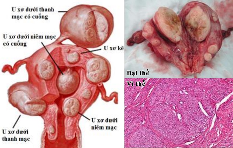 U cơ trơn tử cung là tổ hợp các khối u hình thành và phát triển tại vùng cơ trơn tử cung