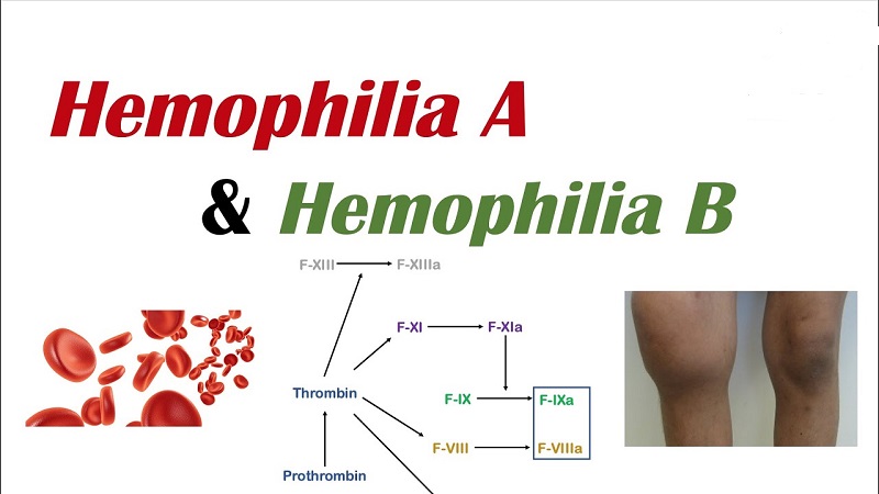 Hemophilia B ít phổ biến hơn Hemophilia A