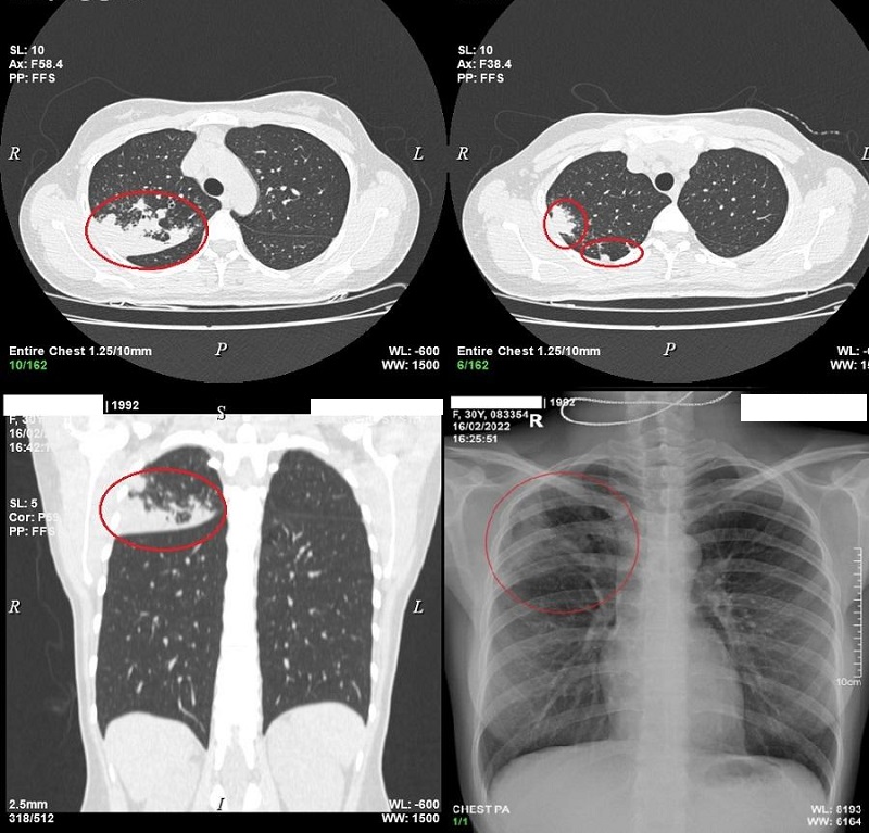 Chụp CT phổi có thể giúp phát hiện những tổn thương ở phổi kể cả khi chưa bị nhiễm Covid