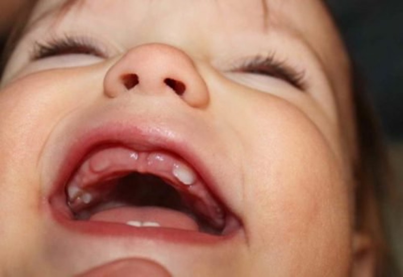 Trẻ có thể bị sốt khi mọc răng