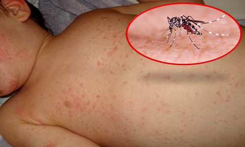 Giai đoạn nguy hiểm của sốt xuất huyết bệnh nhân sẽ xuất hiện xuất huyết dưới da 