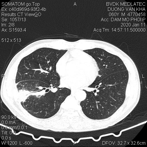 Hình ảnh thu được nhờ công nghệ chụp CT 128 dãy cho thấy bệnh nhân bị ung thư phổi