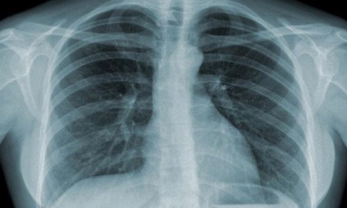 Chụp X - quang phổi cho hình ảnh chính xác