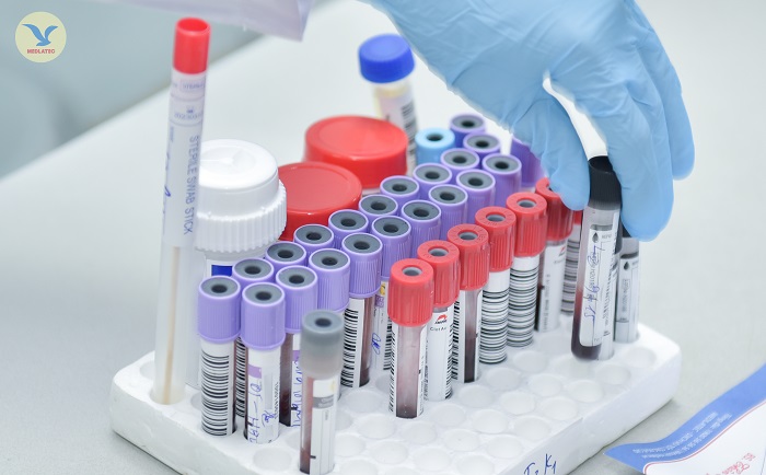 Xét nghiệm máu là một trong những xét nghiệm cần thiết khi bệnh nhân muốn sử dụng dịch vụ xét nghiệm vô sinh nam