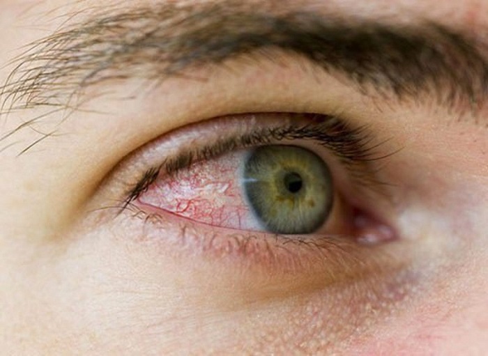 viêm kết mạc mắt  với triệu chứng đặc trưng là đỏ mắt