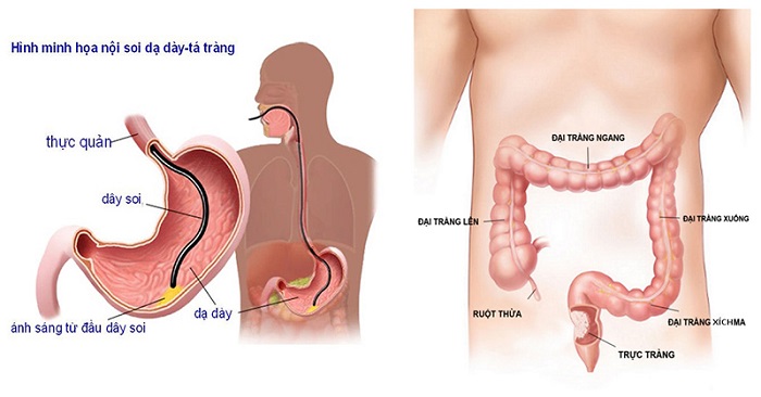 Hình ảnh mô tả phương pháp nội soi dạ dày