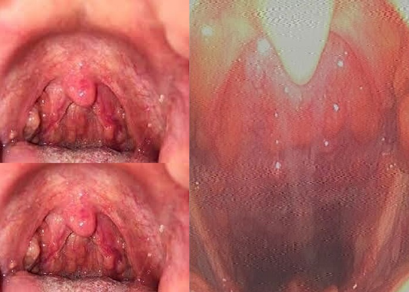 Hình ảnh viêm họng mạn khi nội soi tai mũi họng