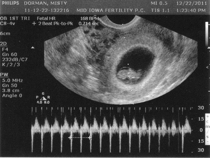 Ở tuần thứ 6 - 8 của thai kỳ, bằng những thiết bị, kỹ thuật hiện đại đã có thể bắt đầu nghe thấy nhịp đập của thai nhi