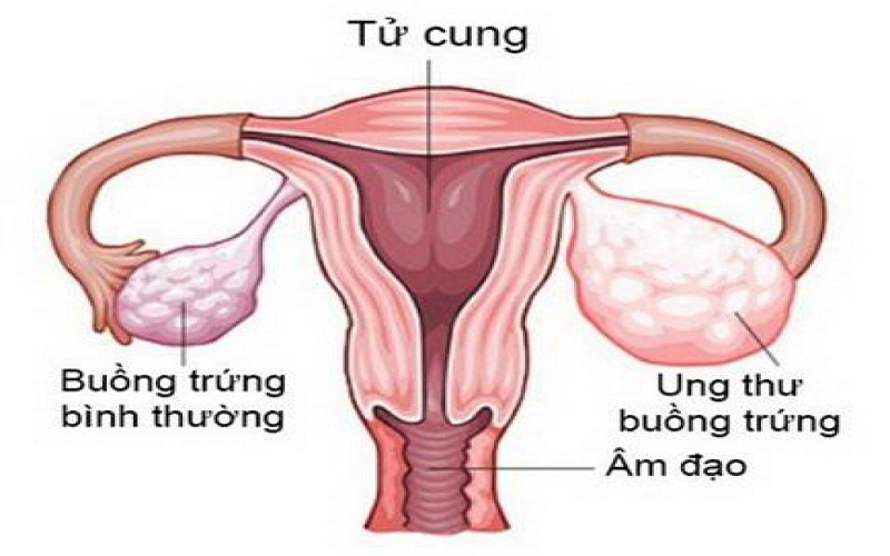 Ung thư buồng trứng là bệnh thường gặp thứ hai của bệnh đường sinh dục nữ