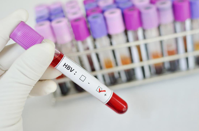Nhiều trường hợp nhận được kết quả xét nghiệm dương tính với viêm gan B mạn tính không có tác nhân delta
