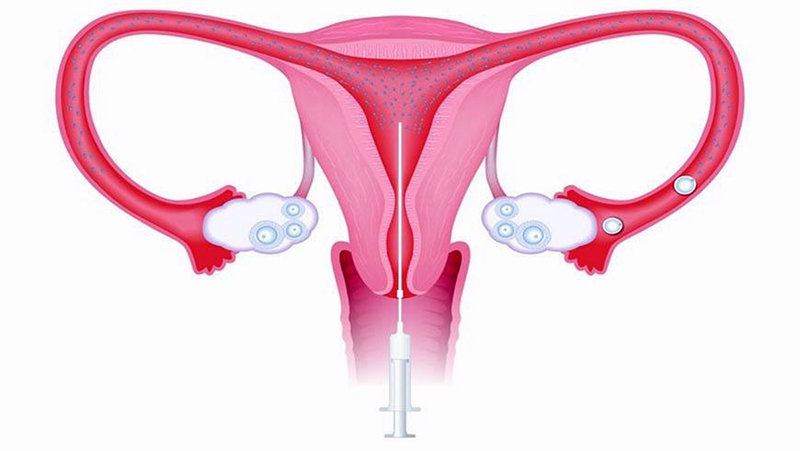 Phương pháp bơm tinh trùng vào buồng tử cung