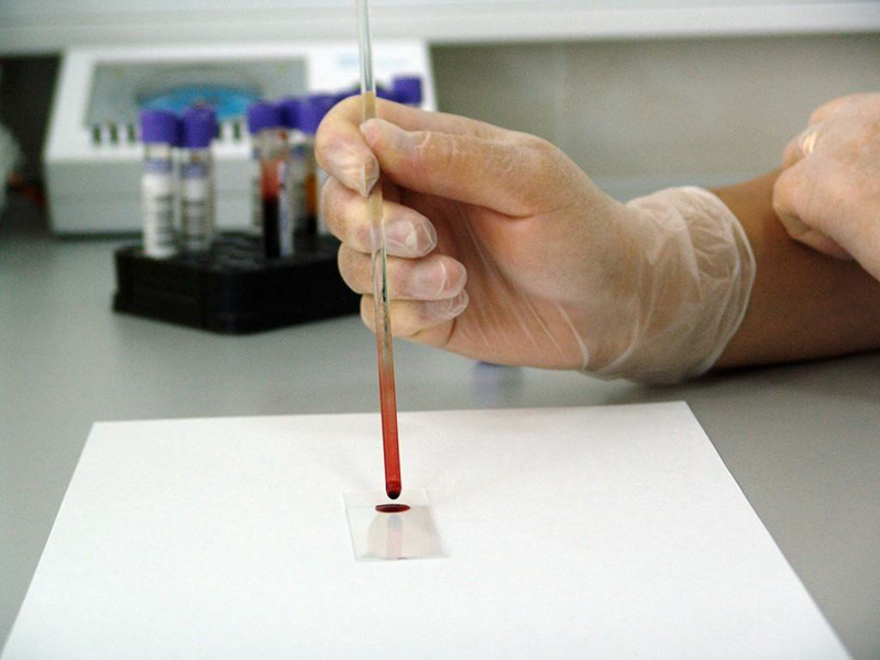 Bác sĩ có thể xác định bệnh tan máu bẩm sinh dựa vào hồng cầu có trong máu của bạn