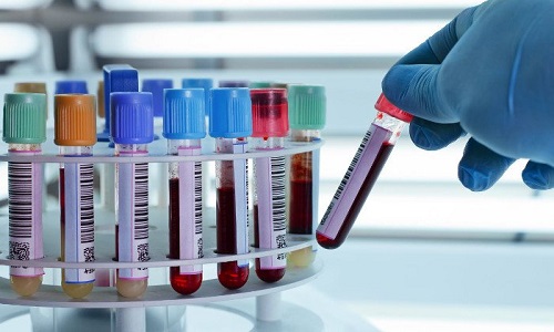 xét nghiệm NS1 giúp phát hiện sốt xuất huyết