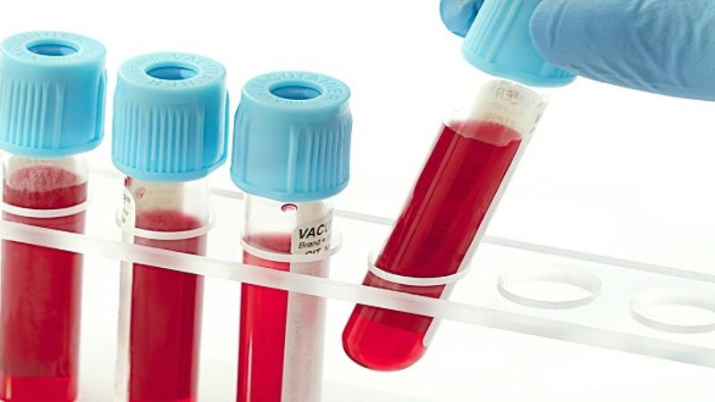 Xét nghiệm máu IGRAs có nhiều ưu điểm trong chẩn đoán lao