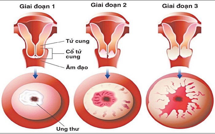 Các giai đoạn của ung thư cổ tử cung 