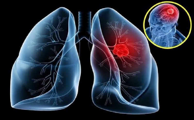 Bệnh ung thư phổi có chiều hướng gia tăng, di căn nhanh chóng