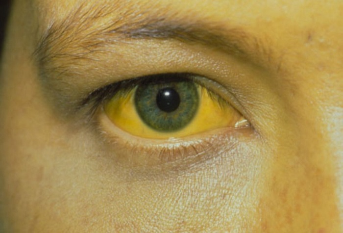 Bệnh nhân xơ gan giai đoạn muộn có thể bị vàng cả vùng mắt