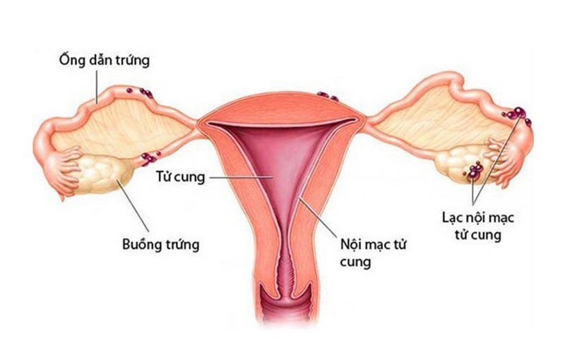 Bệnh lý ở tử cung là một trong những nguyên nhân chính khiến nữ giới bị vô sinh