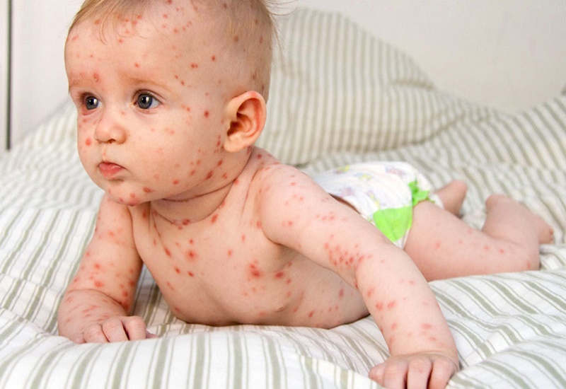 Trẻ có thể bị nổi ban sau cơn sốt