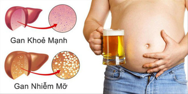 Hạn chế sử dụng bia, rượu để có một lá gan khỏe mạnh