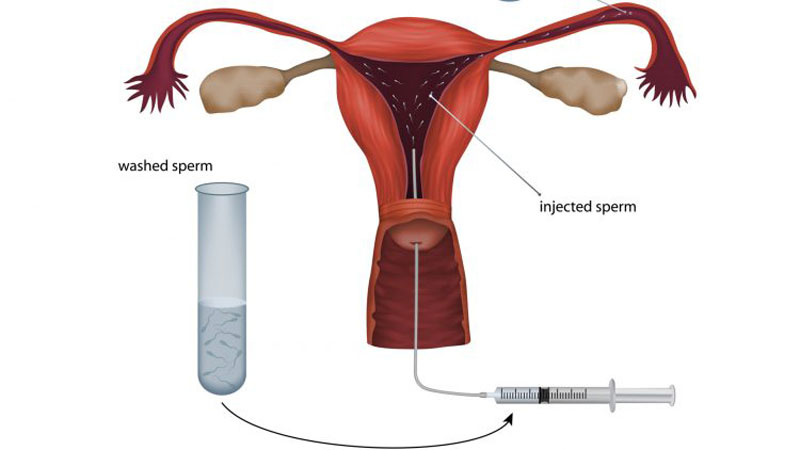 Không phải ai cũng hiểu rõ phương pháp bơm tinh trùng vào tử cung