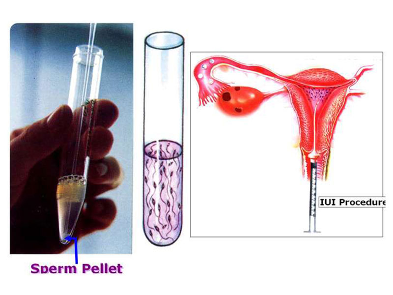 Phải lọc rửa tinh trùng trước khi bơm vào tử cung