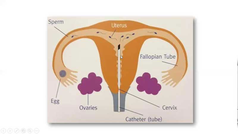 Tìm hiểu phương pháp bơm tinh trùng vào buồng tử cung