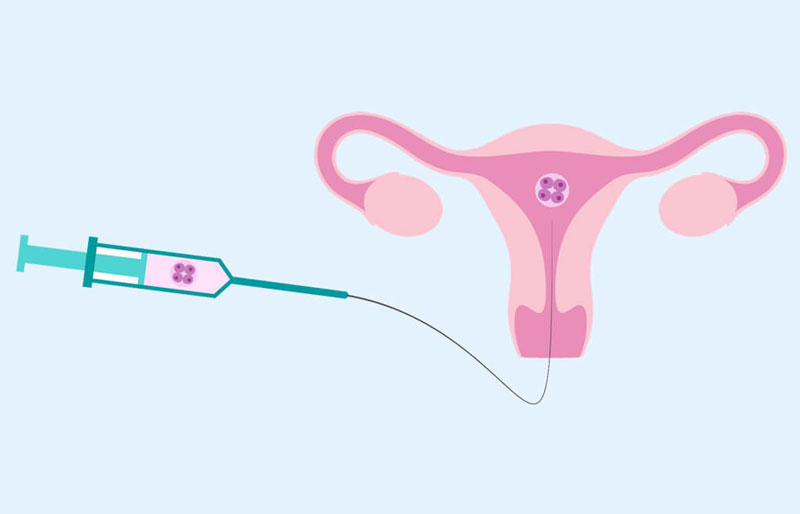 Bơm tinh trùng vào tử cung là gì?
