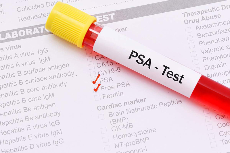 Chỉ số PSA sẽ cho biết tình trạng sức khỏe cụ thể của người bệnh bị mắc ung thư tuyến tiền liệt