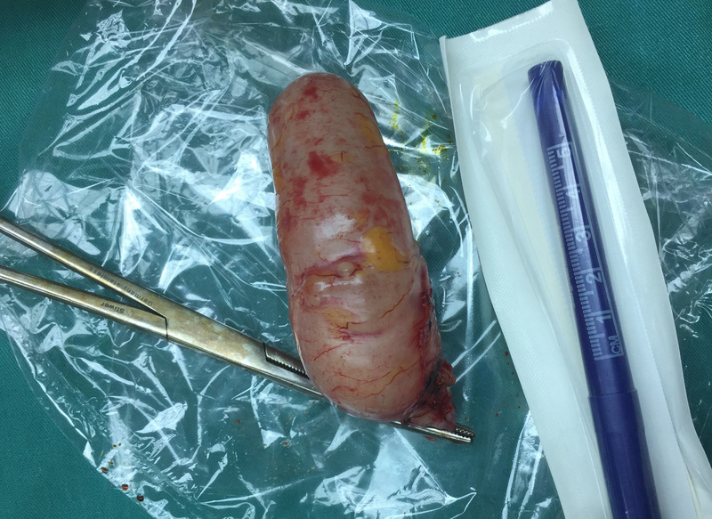 Hình ảnh đoạn ruột thừa vừa được cắt bỏ sau cuộc phẫu thuật