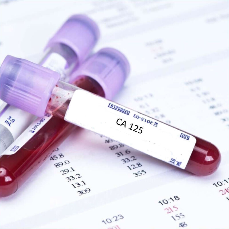 Lấy máu để xét nghiệm nồng độ CA 125 trong huyết thanh