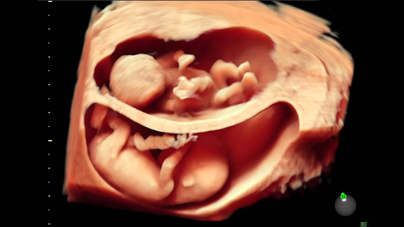 Hình ảnh siêu âm 4D phát hiện song thai