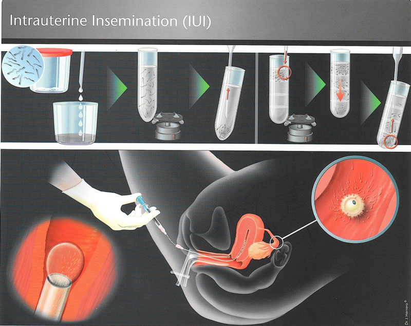 Bơm tinh trùng vào tử cung là phương pháp đang được dùng khá nhiều