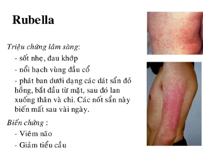 Triệu chứng nhận biết Rubella
