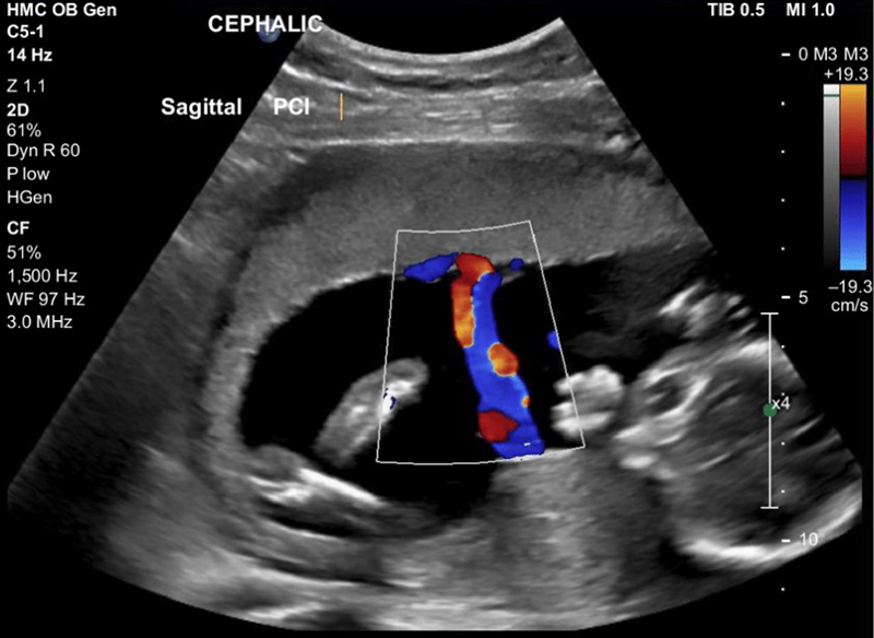 Các mẹ bầu thường được bác sĩ chỉ định siêu âm doppler sau ba tháng đầu thai kỳ