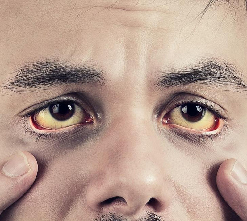 Các triệu chứng của siêu âm gan mật có thể nhận biết bằng mắt thường