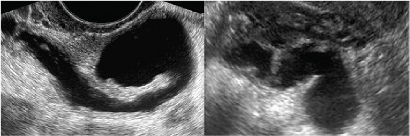 Hình ảnh bệnh lý vòi trứng trên siêu âm đầu dò