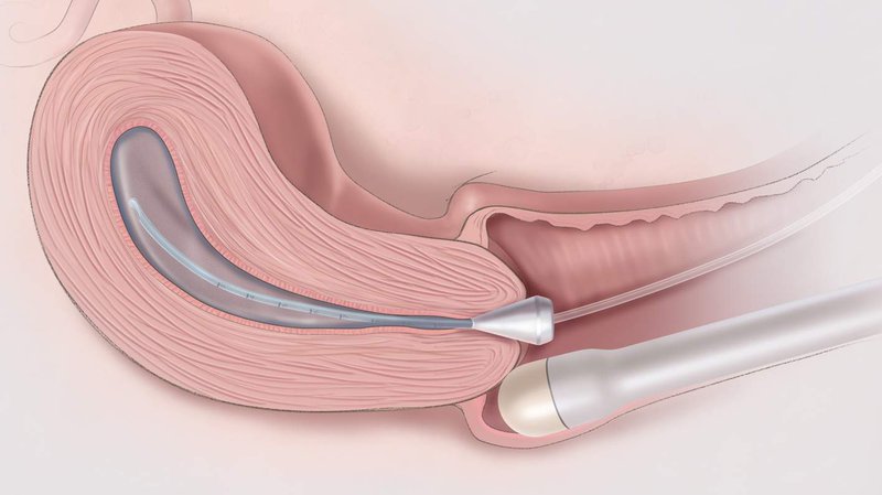 Siêu âm đầu dò là phương pháp được sử dụng chủ yếu khi bệnh nhân có nhu cầu thăm khám tử cung