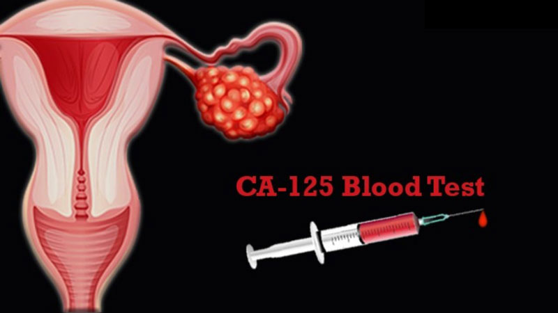 Xét nghiệm CA - 125 cho phép kiểm tra nồng độ protein trong máu