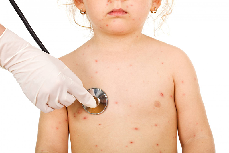 Viêm phổi là một trong những biến chứng nguy hiểm của thủy đậu ở trẻ