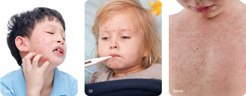 Sởi - quai bị - rubella là 3 bệnh truyền nhiễm thường gặp nhất là ở trẻ nhỏ