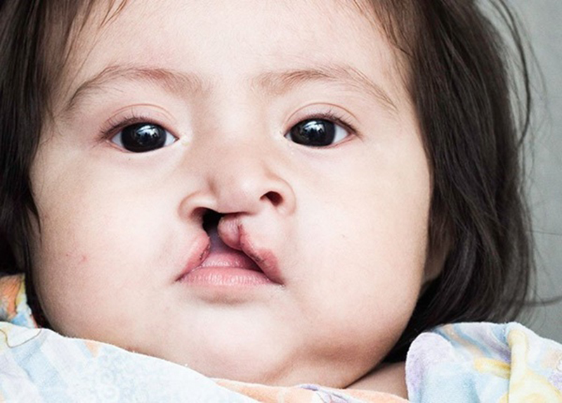 Trẻ bị sứt môi do người mẹ bị cúm trong tháng đầu mang thai