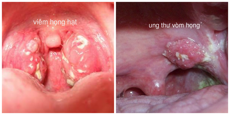 Nội soi ở vòm họng giúp phát hiện những bất thường bên trong cổ họng, mũi, thanh quản