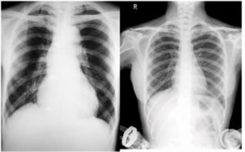 <a href='https://medlatec.vn/tin-tuc/chup-x--quang-phoi-co-the-phat-hien-benh-gi-s28-n11026'  title ='Chụp X quang phổi'>Chụp X quang phổi</a> có vết mờ