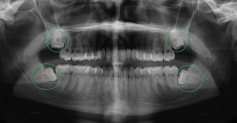 <a href='https://medlatec.vn/tin-tuc/medlatec--dia-chi-chup-xquang-rang-o-ha-noi-uy-tin-s154-n20066'  title ='Chụp X quang răng'>Chụp X quang răng</a> khôn