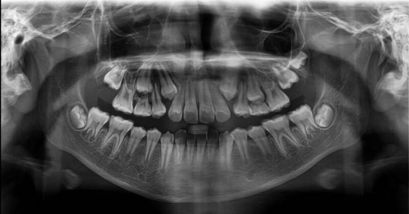 <a href='https://medlatec.vn/tin-tuc/nguyen-ly-chup-x--quang-va-nhung-van-de-ai-ai-cung-nen-biet-s154-n17538'  title ='chụp X quang'>chụp X quang</a> xương hàm