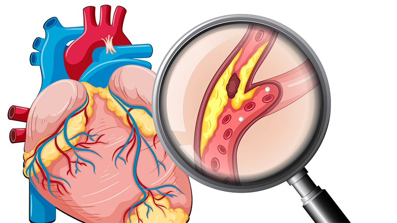 Nhồi máu cơ tim là hiện tượng các động mạch vành bị tắc nghẽn
