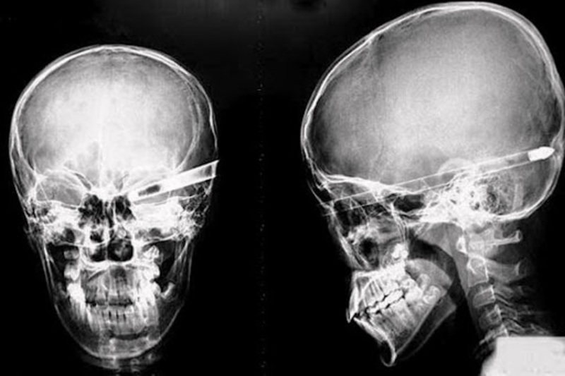 chụp X quang sọ não