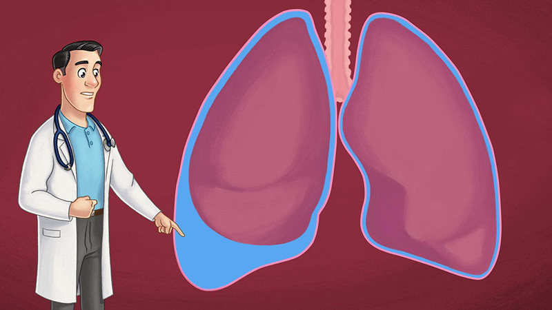 Siêu âm màng phổi nhằm mục đích phát hiện và đánh giá tính chất dịch màng phổi